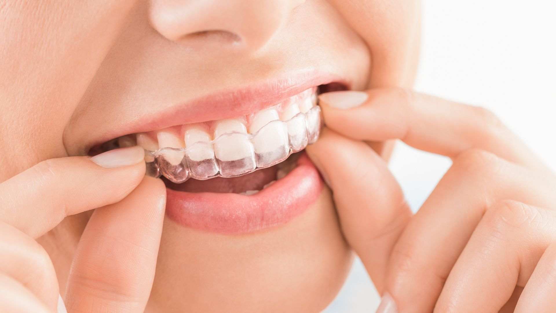 colocar retenedor dental